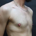 Transgender/Top Surgery Before & After Patient #12206