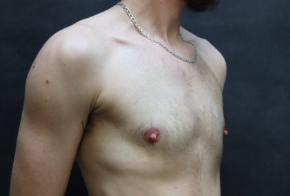 Transgender/Top Surgery Before & After Patient #12206