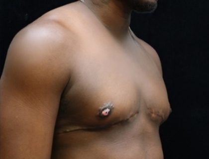 Transgender/Top Surgery Before & After Patient #12207