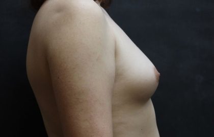 Transgender/Top Surgery Before & After Patient #12209