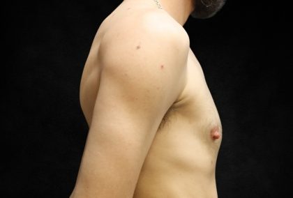Transgender/Top Surgery Before & After Patient #12206