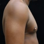 Transgender/Top Surgery Before & After Patient #12207