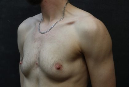 Transgender/Top Surgery Before & After Patient #12206