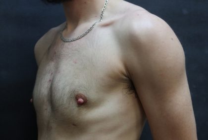 Transgender/Top Surgery Before & After Patient #12206