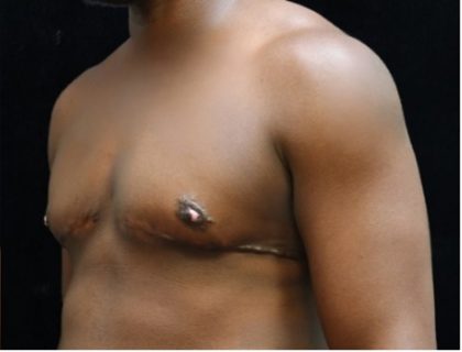 Transgender/Top Surgery Before & After Patient #12207