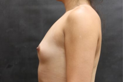 Transgender/Top Surgery Before & After Patient #12208