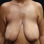 Breast Lift Before & After Patient #12410