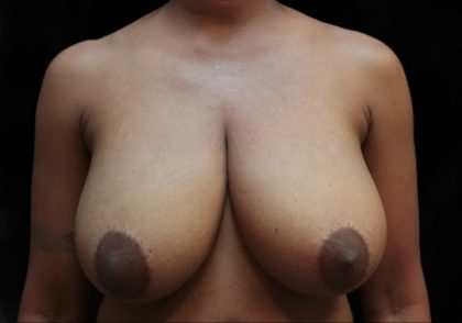 Breast Reduction Before & After Patient #12530