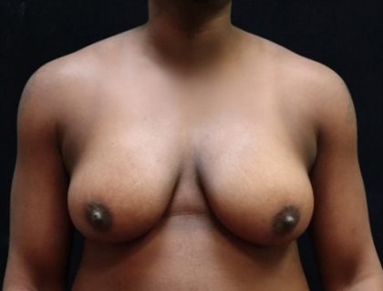 Breast Reduction Before & After Patient #12544
