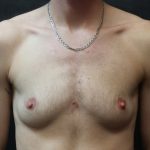 Breast Reduction Before & After Patient #12545