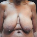 Breast Lift Before & After Patient #12743
