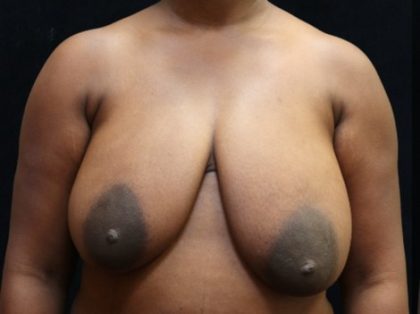 Breast Lift Before & After Patient #12758