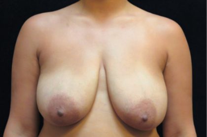 Breast Asymmetry Before & After Patient #12336