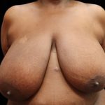 Breast Reduction Before & After Patient #12812