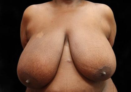 Breast Reduction Before & After Patient #12812