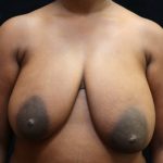 Breast Reduction Before & After Patient #12819