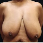 Breast Asymmetry Before & After Patient #12341