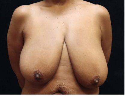 Breast Asymmetry Before & After Patient #12341