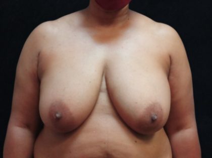 Breast Reduction Before & After Patient #12876