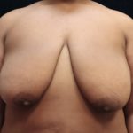 Breast Reduction Before & After Patient #12897
