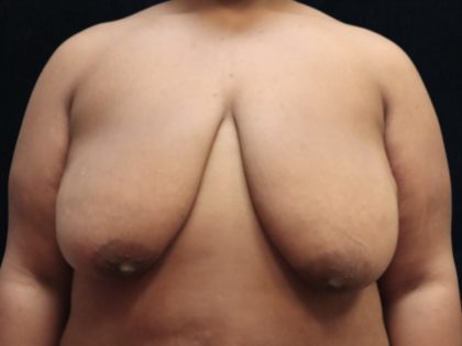 Breast Reduction Before & After Patient #12897