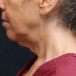Chin Augmentation Before & After Patient #12904