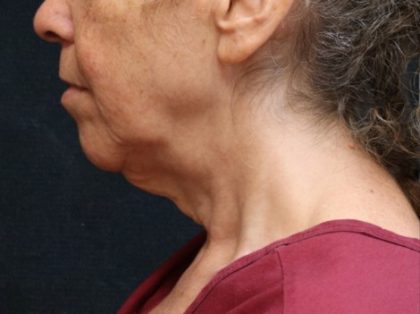 Chin Augmentation Before & After Patient #12904
