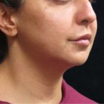 Chin Augmentation Before & After Patient #12913