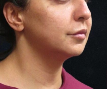 Chin Augmentation Before & After Patient #12913