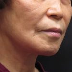 Chin Augmentation Before & After Patient #12929