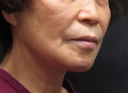Chin Augmentation Before & After Patient #12929