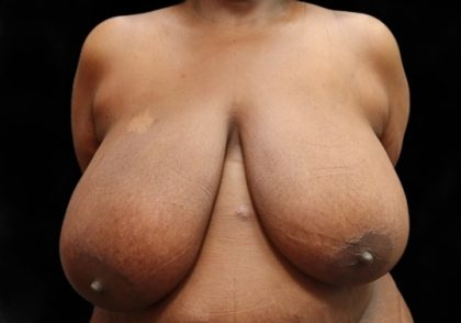 Breast Asymmetry Before & After Patient #13035