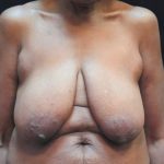 Breast Reduction Before & After Patient #12801