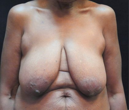 Breast Reduction Before & After Patient #12801