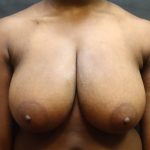 Breast Reduction Before & After Patient #13027