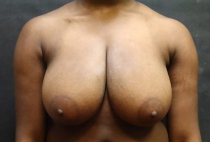 Breast Reduction Before & After Patient #13027