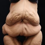 Lower Body Lift Before & After Patient #13044