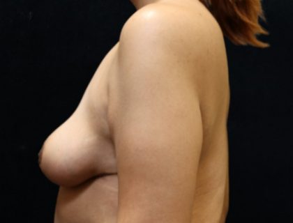 Breast Lift Before & After Patient #12410