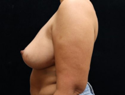 Breast Reduction Before & After Patient #12533