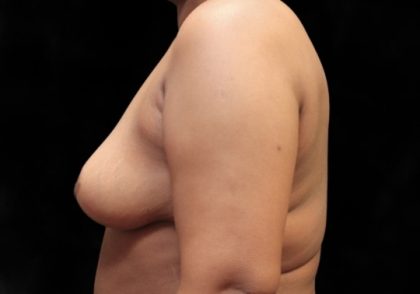 Breast Reduction Before & After Patient #12534