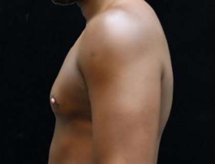 Breast Reduction Before & After Patient #12544