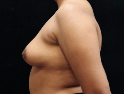 Breast Reduction Before & After Patient #12858
