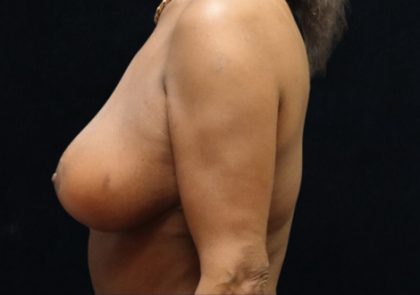 Breast Asymmetry Before & After Patient #12340