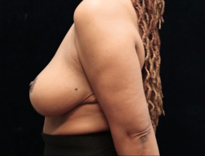 Breast Asymmetry Before & After Patient #12341
