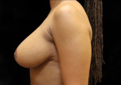 Breast Lift Before & After Patient #12402