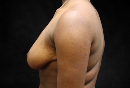 Breast Reduction Before & After Patient #13027