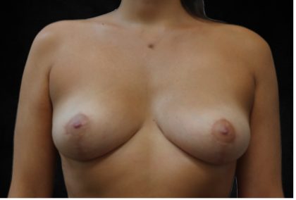 Breast Lift Before & After Patient #12412