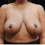 Breast Reduction Before & After Patient #12543