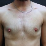 Breast Reduction Before & After Patient #12545
