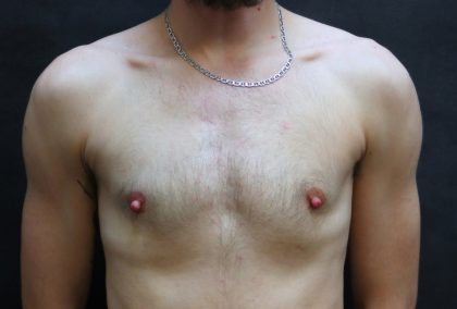 Breast Reduction Before & After Patient #12545